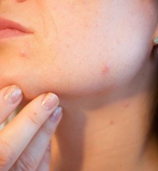 Aknebehandling: Få klar, glødende hud uten urenhet
