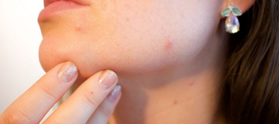 Aknebehandling: Få klar, glødende hud uten urenhet